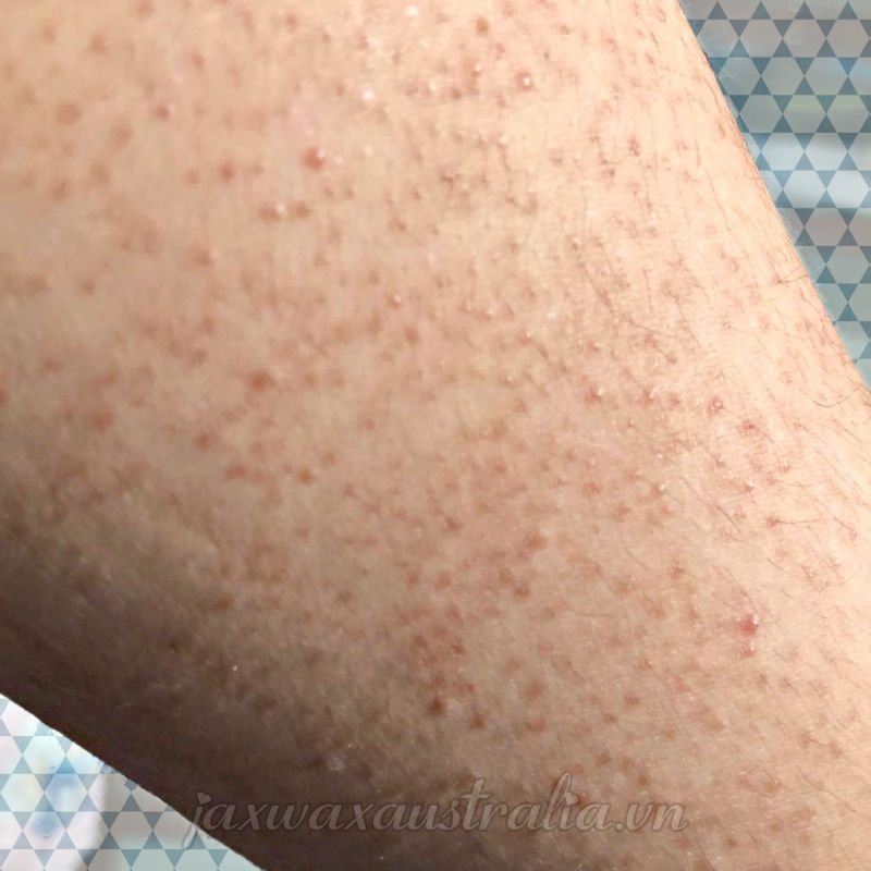 Lông mọc ngược: nguyên nhân và cách điều trị